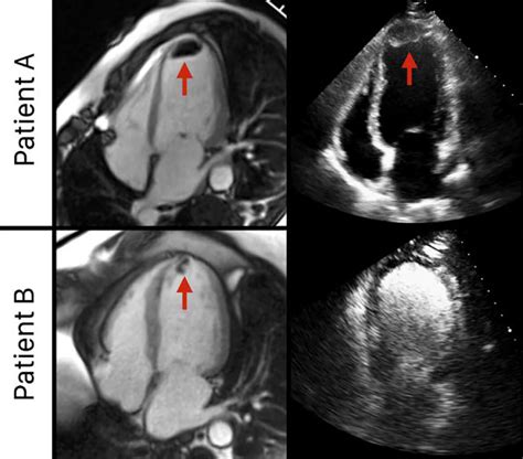 left ventricular thrombus heart attack.